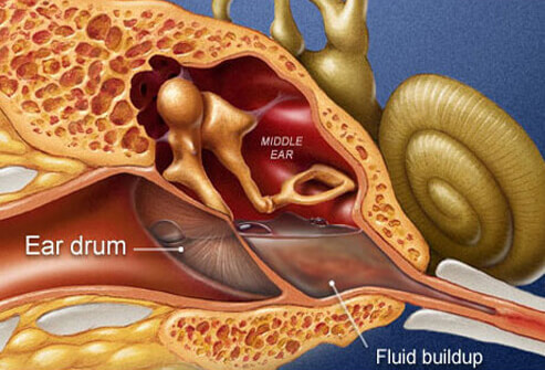 ear-infection