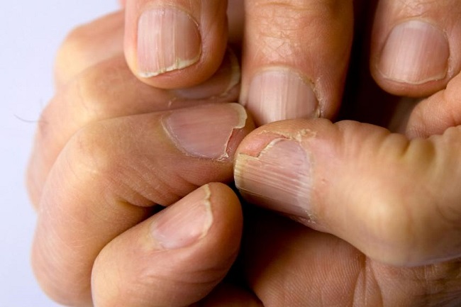 Abnormalities of Nails