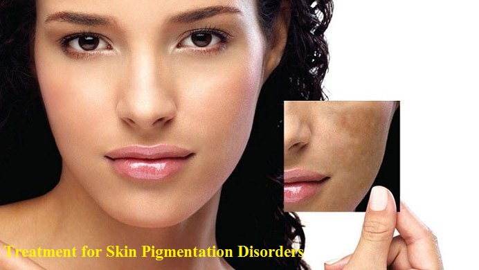Treatment-for-Skin-Pigmentation-Disorders